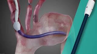 Nexus® Aoritc Arch Stent Graft Procedure Animation