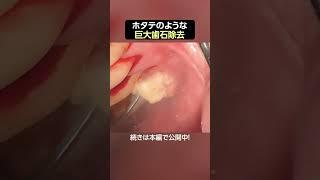【歯石除去】ホタテのような巨大歯石 #歯医者 #歯石除去 #dentist #ザホワイトデンタルクリニック