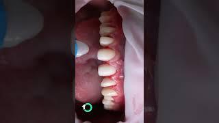E-max Dental Veneers Installation at One Clinic: The Latest Technology for a Perfect Smile!