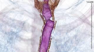 tracheal stenosis