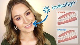 Unsichtbare Zahnspange ?   INVISALIGN Kosten | Erfahrung | Schmerzen