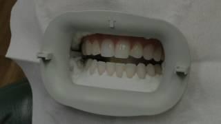 Zoom Teeth Whitening