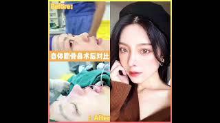 自體肋骨鼻術後對比 | Autologous Ribs Nose Post Surgery Comparison  #推薦 #医美 #beauty #鼻子 #肋骨鼻