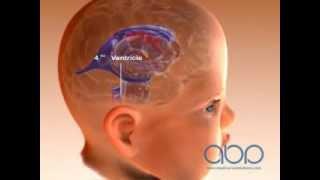 Brain Ventricle of a Baby