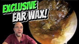 EXCLUSIVE EAR WAX! 334 #ear #earwax #earwaxremoval #asmr #satisfying #foryou #fyp #foryourpage