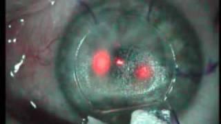 Lasik Eye Surgery Procedure Video