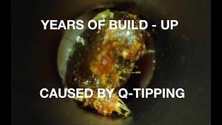 YEARS OF WAX BUILD-UP : EAR WAX REMOVAL : 4K-HD