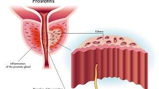 Wise Anderson Protocol- Prostatitis: Clearing Up the Confussion Part A