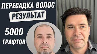 Пересадка Волос в Турции До и После 5000 графтов | Пересадка волос в Турции