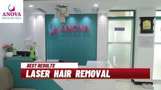 LASER HAIR REMOVAL