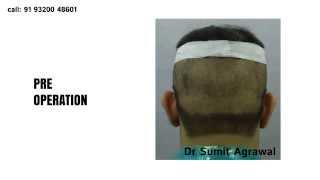 FUE Hair Transplant in Mumbai - Harleys Clinic