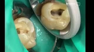 Endodoncia Tenerife Paso a Paso Brident Odontologos CanariasClínicas Dentales Tenerife