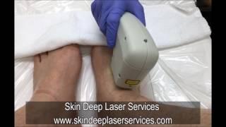 Laser Hair Removal, Painless and Fast,Skin Deep, Burke VA, Northern Virginia Hair Removal