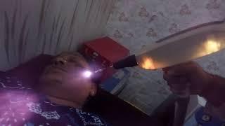 Laser carbon Facial in Zirakpur