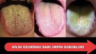 Dilimizin üzərindəki sarı ərpin səbəbləri