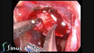 Endoscopic Pituitary Surgery