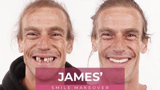 James' Dental Implants Smile Makeover Journey at Dental Boutique