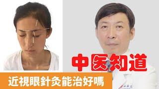 近視眼針灸能治好嗎【保健養生】生生不息┃