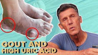 Keto and Carnivore's Biggest Fear: Gout and High Uric Acid