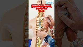 गर्दन के दर्द या नस दबने का इलाज | C4-C5, C5-C6, C6-C7 Disc Bulge / Cervical Problem #shorts #viral