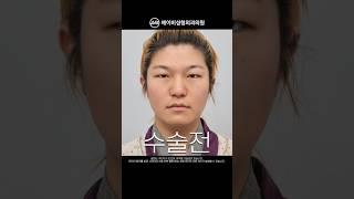 [MAKE ME Girl] ※놀람주의※ 역대급 성형 전후 | 맥미걸 #shorts