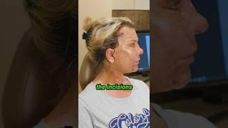 5 Days Post-Op | Deep Plane Face & Neck Lift #cosmeticsurgery #face  #antiaging