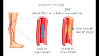 DAOP - Doença Arterial Obstrutiva Periférica