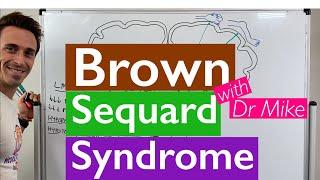 Brown Sequard Syndrome