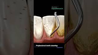 Tooth Cleaning | Teeth Scaling I stain or Tartar Removal cost | Dentalexperience.in