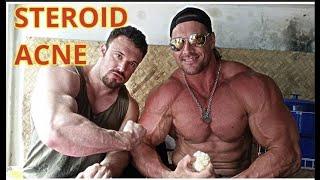 STEROID ACNE SIDE EFFECTS