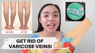 HOW TO GET RID OF VARICOSE VEINS | ORGANIC VARICOSE VEIN HEALING CREAM BY SOO YUN™