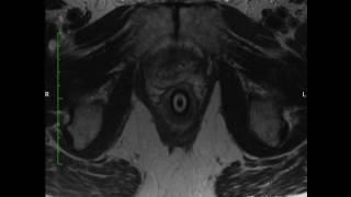 Mrgbx Prostate Mri Tz And Pz AX T2 impossible to see lesion at base