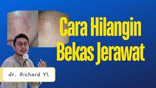 Cara menghilangkan Bekas Jerawat | Dokter Richard YL