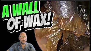 A WALL OF WAX! 304 #ear #earwax #earwaxremoval #earcleaning #foryou #asmr #asmrearwax #satisfying