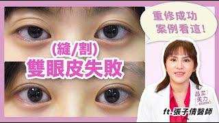 雙眼皮重修｜雙眼皮失敗！雙眼皮割壞？眼皮縫壞？雙眼不對稱？多眼皮？失敗雙眼皮怎麼辦？！【晶華醫美診所】張子倩醫師｜晶華美力GOOD｜雙眼皮重修推薦 台北雙眼皮重修手術推薦 台北雙眼皮重修醫師推薦