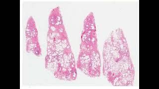 Usual Interstitial Pneumonia