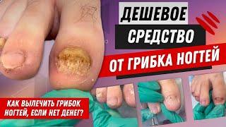 Дешевое средство от грибка ногтей/ Как вылечить грибок ногтей, если нет денег? #ногти #грибокногтей