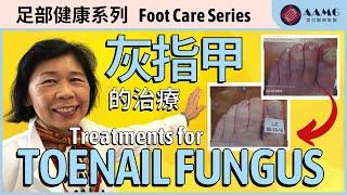 (中文字幕) 足科醫生為你介紹灰指甲的治療方法 Foot Doctor Explains Treatments for Toenail Fungus | 美亞醫療集團 AAMG