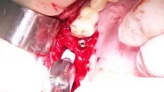 16 may 2014. Ilya Makaryevskiy + Implay Implants. Immed. Imp. Part 1