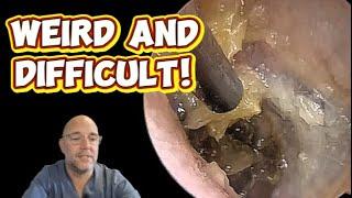 WEIRD & DIFFICULT! 337 #ear #earwax #earwaxremoval #asmr #satisfying #foryou #fyp #foryourpage