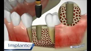 Procedimiento Implantes.