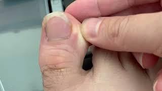 Ingrown Toenail Home Remedy Treatment