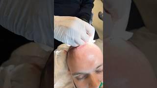 Incisions for a hair transplant at DrT Hair  #drtayfunoguzoglu #hairtransplant #haartransplant