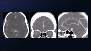 Bifrontal Craniotomy for Clip Reconstruction of Pericallosal Artery Aneurysm