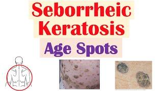 Seborrheic Keratosis (“Age Spots”) | Risk Factors, Causes, Skin Lesions, Diagnosis, Treatment