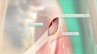 Meralgia Paresthetica Surgery