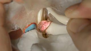 Disc Herniation Model | Dynamic Disc Designs Corp.