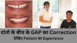 दांतो के बीच के GAP का Correction | Patient ka Experience | Seraphic Dental Indore | Dr Vishakha