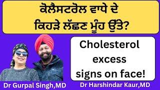 Cholesterol excess signs on face !! ਕੋਲੈਸਟਰੋਲ ਵਾਧੇ ਦੇ ਕਿਹੜੇ ਲੱਛਣ ਮੂੰਹ ਉੱਤੇ ਦਿਸਦੇ ਹਨ!(369)