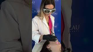 LÁSER LUMIIA PARA ACNÉ ACTIVO  #laser #acne #dermatologia #estetica